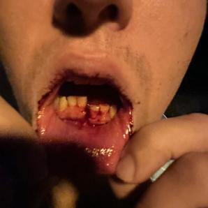 [VIDEO] RUTKOWSKI W AKCJI: Pobicie młodego człowieka w Jastarni. Poszkodowany w szpitalu. Sprawca nagrany, są dowody. Przerażający brak reakcji policji z Juraty!